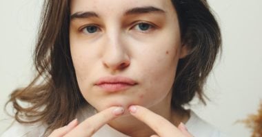 حب الشباب.. لماذا تظهر الحبوب في الظهر والكتفين وكيف يمكن التخلص منها؟