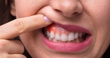 10 عادات يومية تضر بصحة أسنانك ولثتك.. توقف عنها