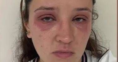 حساسية شديدة بسبب الرموش الصناعية.. عروس بريطانية تروى تجربتها