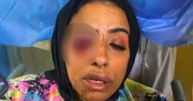فقدت عينها.. تفاصيل واقعة التعدي على موظفة إحدى شركات القروض في دمياط